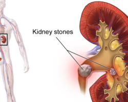 पथरी-Kidney-Stone