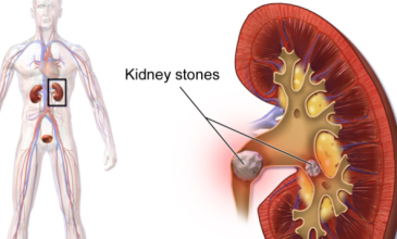 पथरी-Kidney-Stone