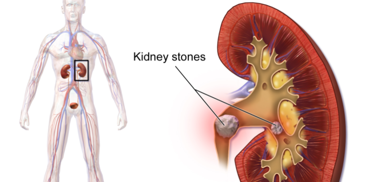 पथरी-Kidney-Stone